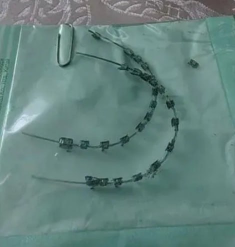 Есть желающие поносить? Россияне стали продавать использованные брекеты