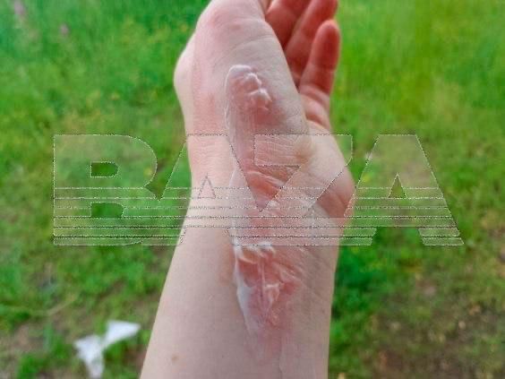 Жительница Читы получила ожоги из-за взрыва жидкости для розжига Жительница Читы получила ожоги из-за взрыва жидкости для розжига