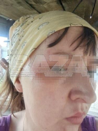 Жительница Читы получила ожоги из-за взрыва жидкости для розжига