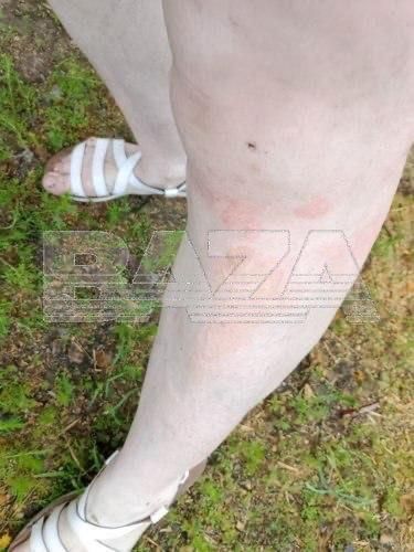 Жительница Читы получила ожоги из-за взрыва жидкости для розжига Жительница Читы получила ожоги из-за взрыва жидкости для розжига