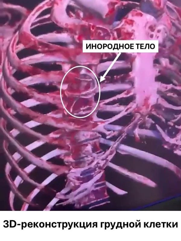 Королёвские врачи спасли пациента с инородным телом в лёгочной артерии Королёвские врачи спасли пациента с инородным телом в лёгочной артерии