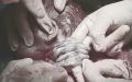 В Серпуховском роддоме приняли естественные роды с четырехкратным обвитием пуповины